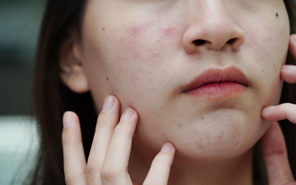 Woman touching face with visible skin discoloration and imperfections.